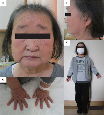 Case report: Late middle-aged features of FAM111A variant, Kenny–Caffey syndrome type 2-suggestive symptoms during a long follow-up